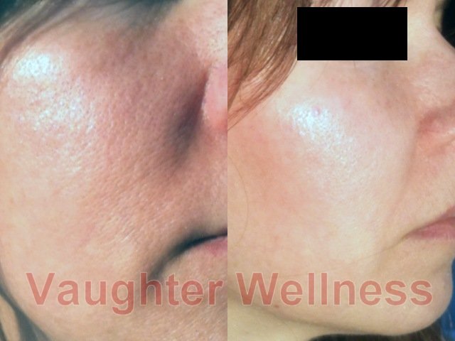 cheek before and after demarolling